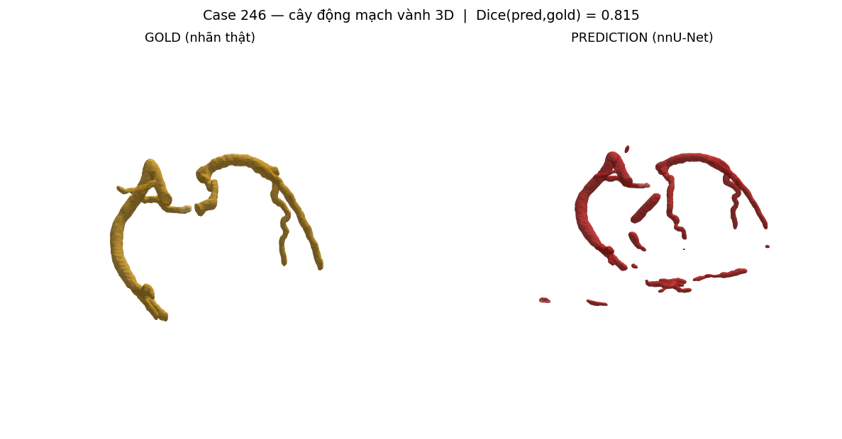 ca 246 coronary 3D