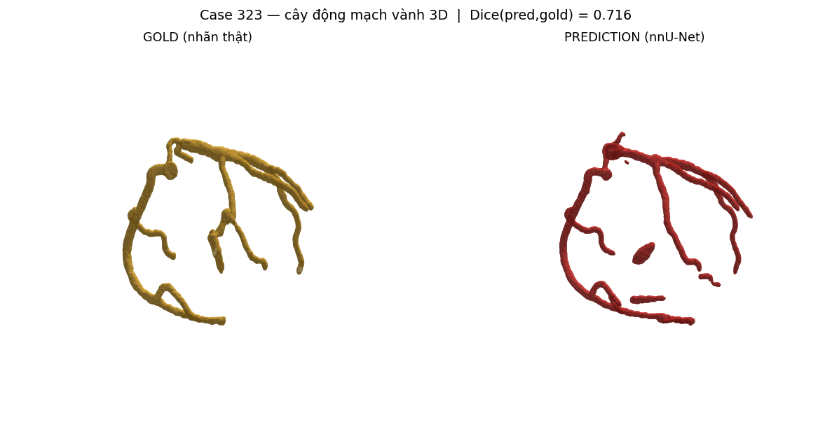 ca 323 coronary 3D