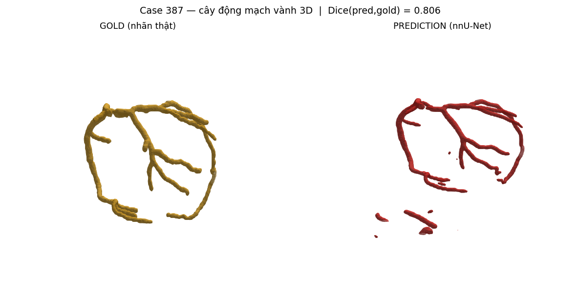 ca 387 coronary 3D