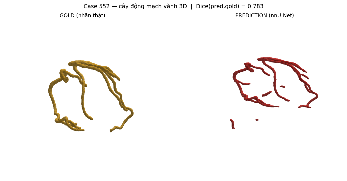 ca 552 coronary 3D