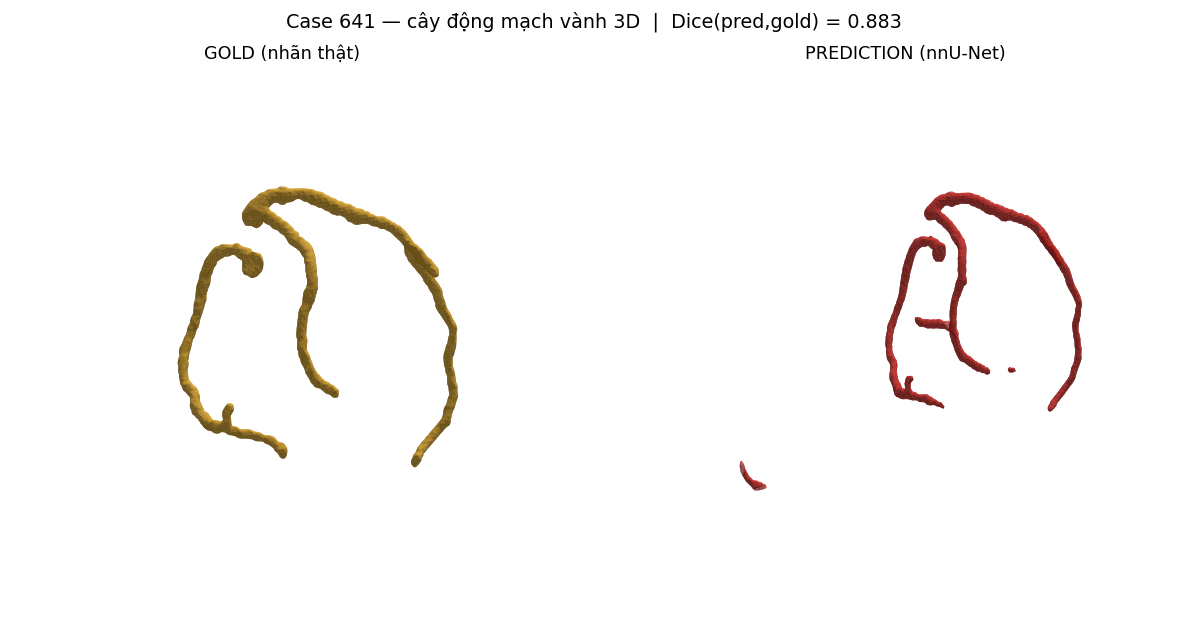 ca 641 coronary 3D