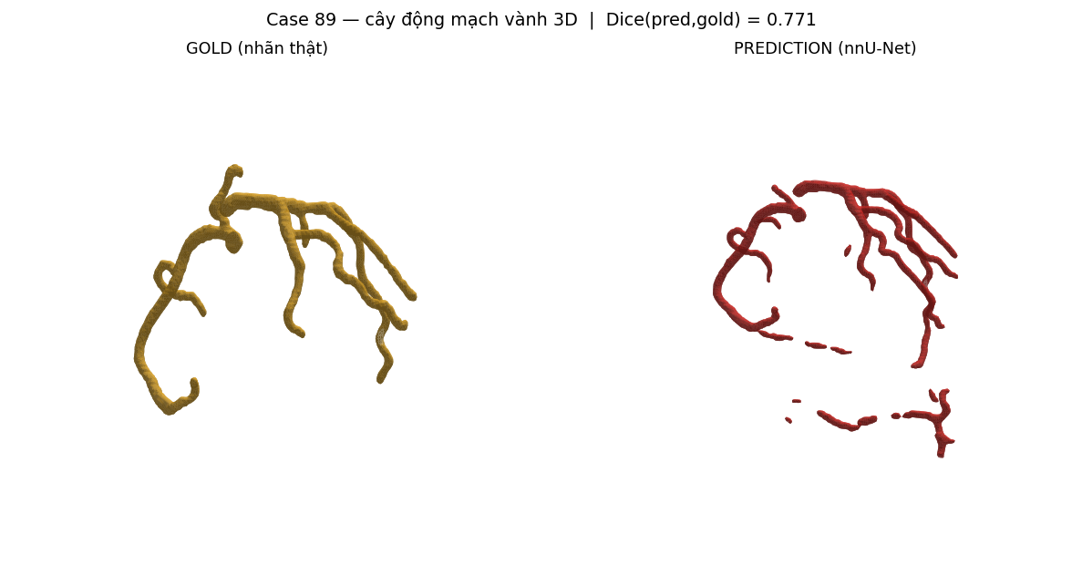 ca 89 coronary 3D