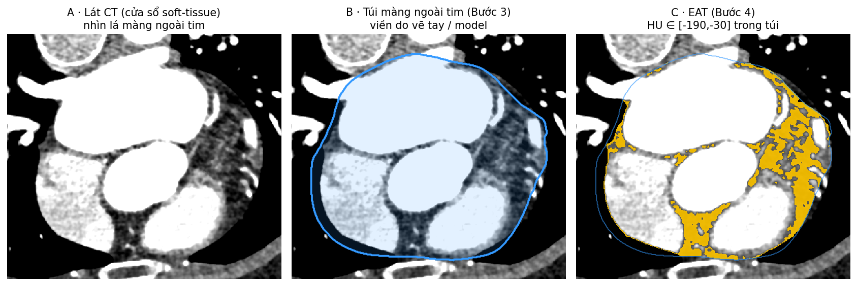 Ba lát CT axial: ảnh gốc, túi màng ngoài tim viền xanh, EAT màu hổ phách trong túi
