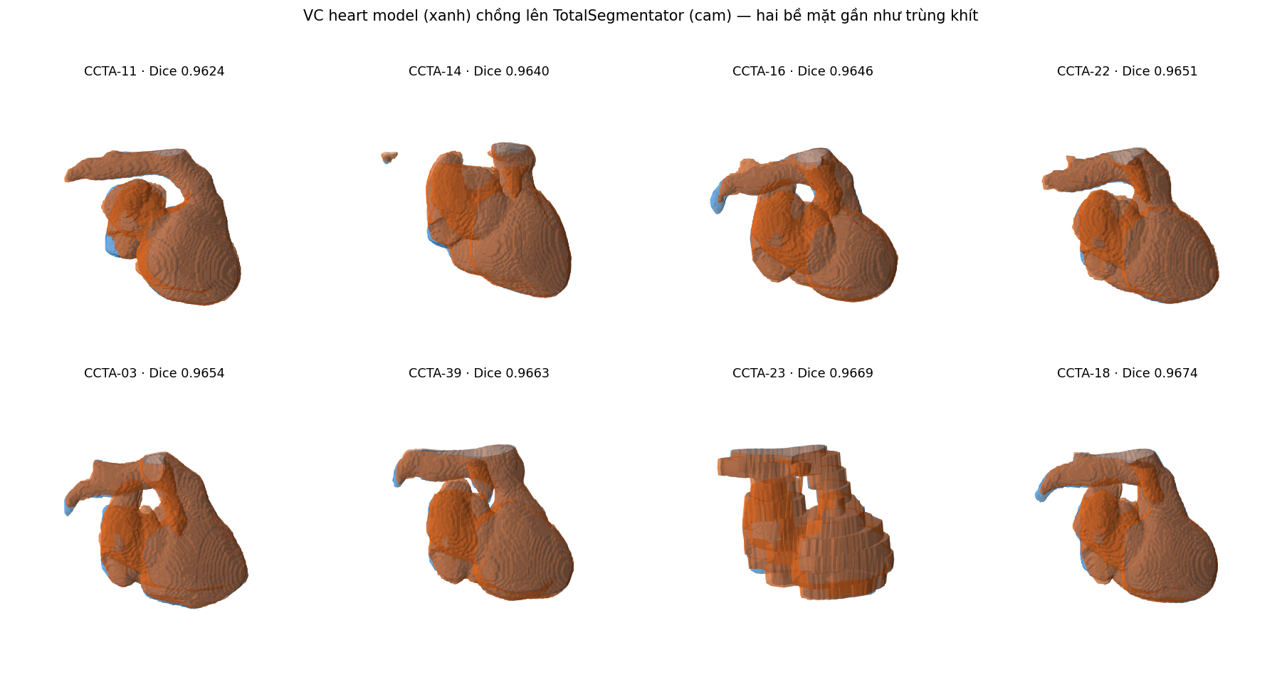 Lưới 3D 8 ca: bề mặt tim VC model chồng lên TotalSegmentator