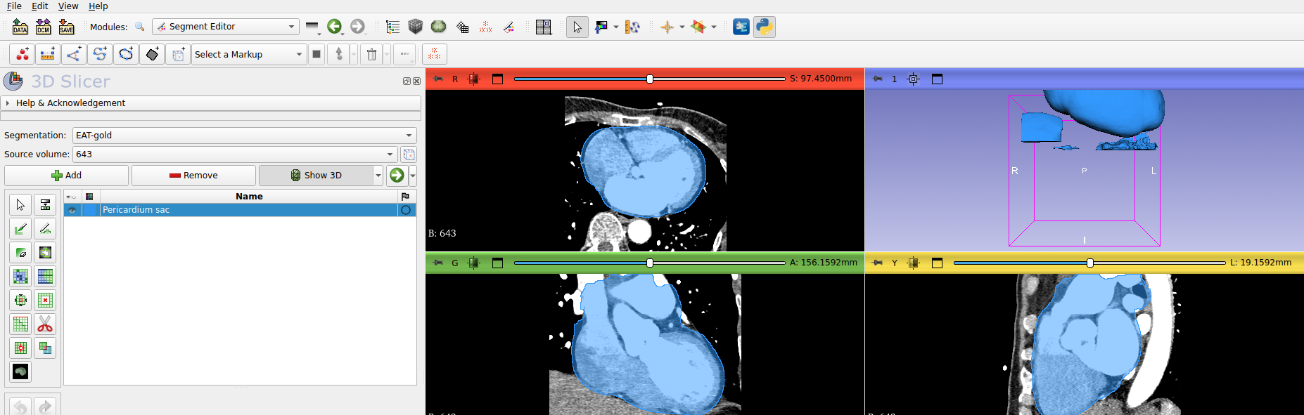 Segment Editor với segment Pericardium sac phủ xanh trên tim